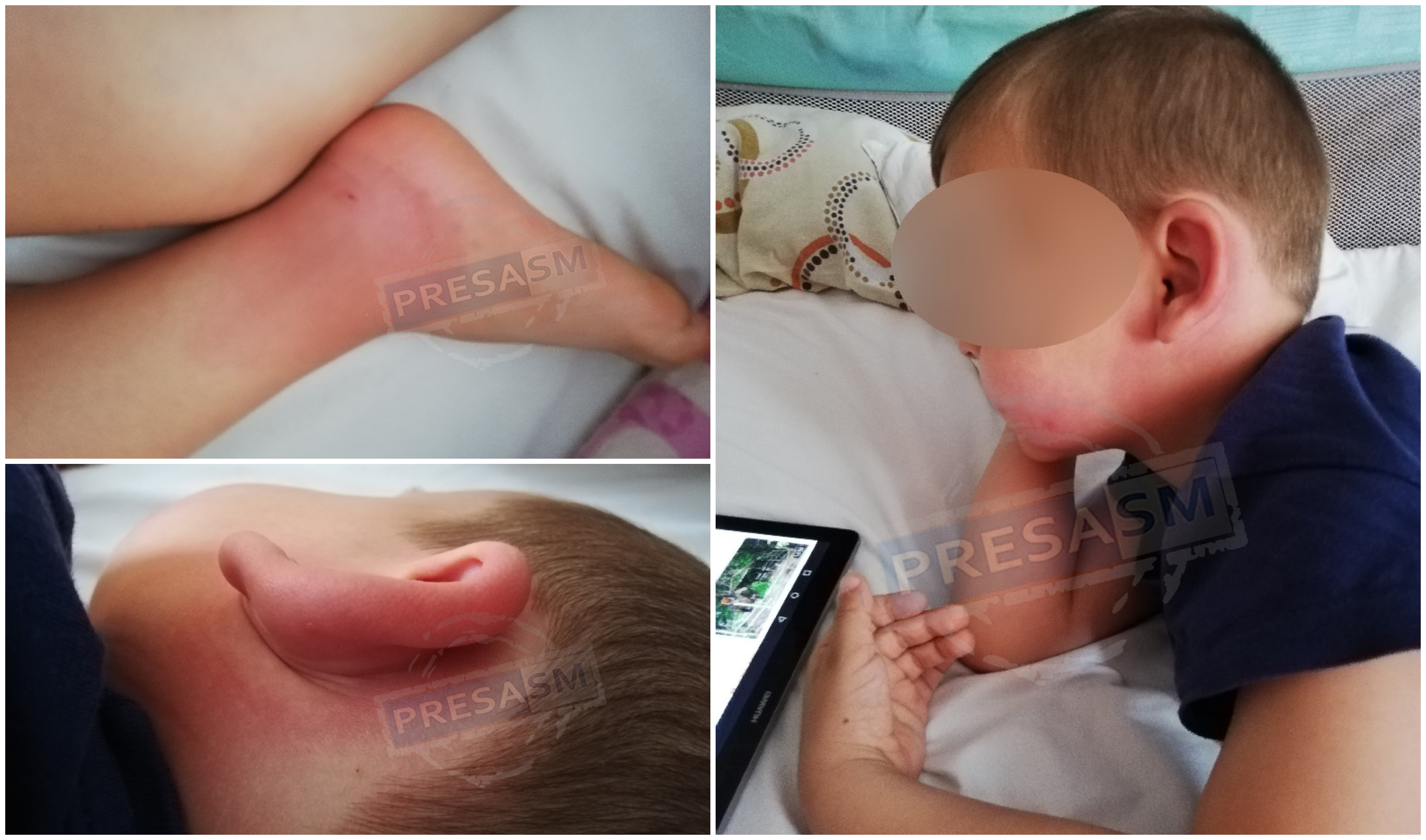 FOTO. Copii ”devorați” de țânțari în municipiul Satu Mare. Mâine începe marea dezinsecție