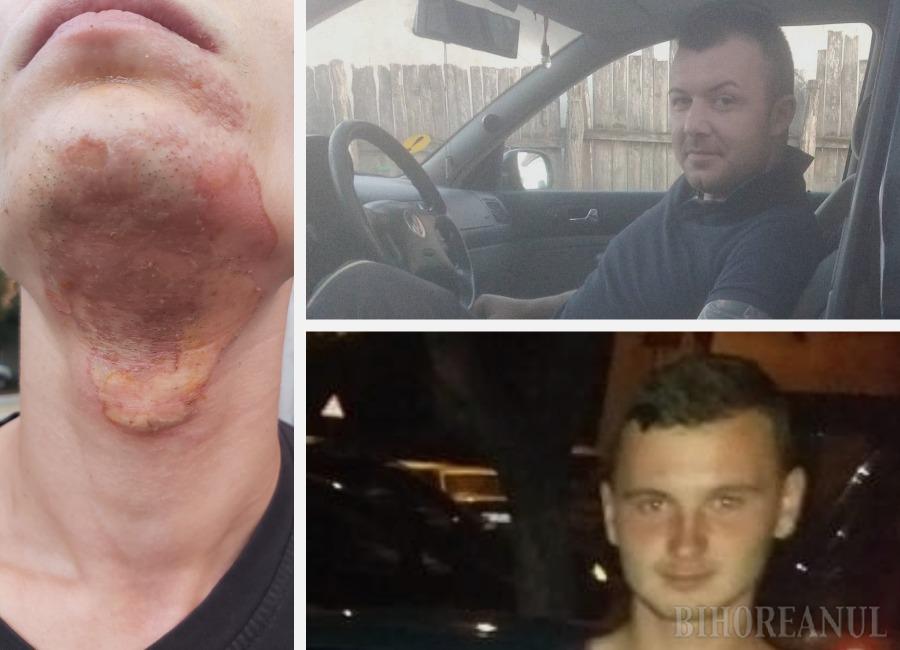 FOTO. Tânăr cu handicap brutalizat de colegii de muncă. Ars cu țigara, bătut și înjurat în mod continuu!