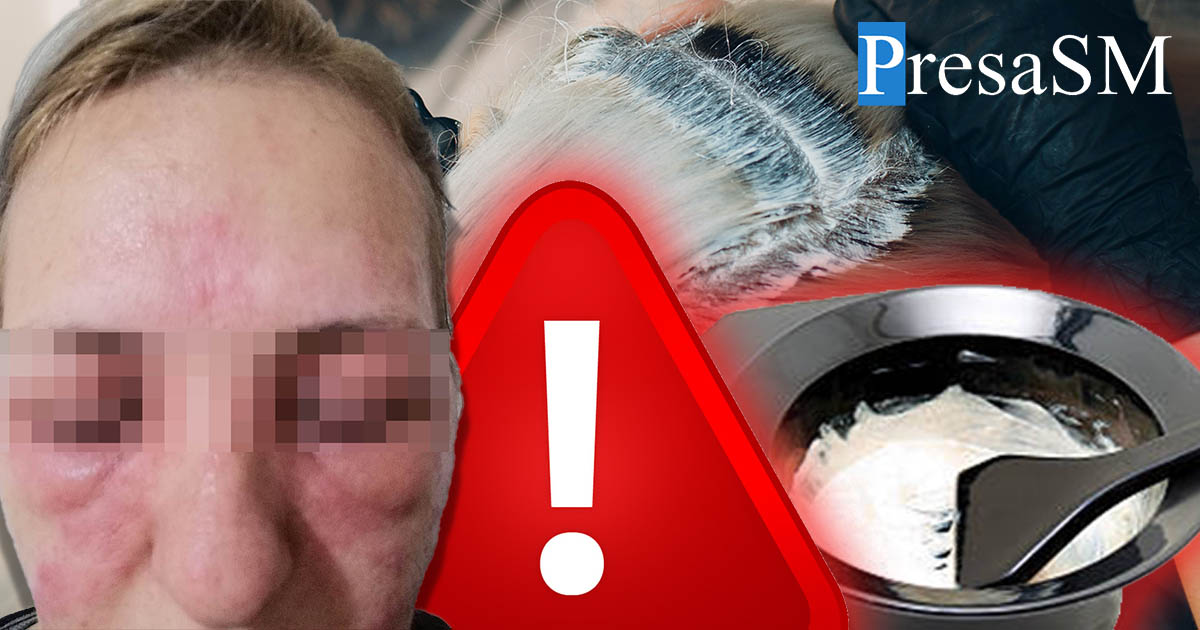 FOTO. Atenție mare la vopseaua de păr! A pățit-o o sătmăreancă. A ajuns direct la Urgențe