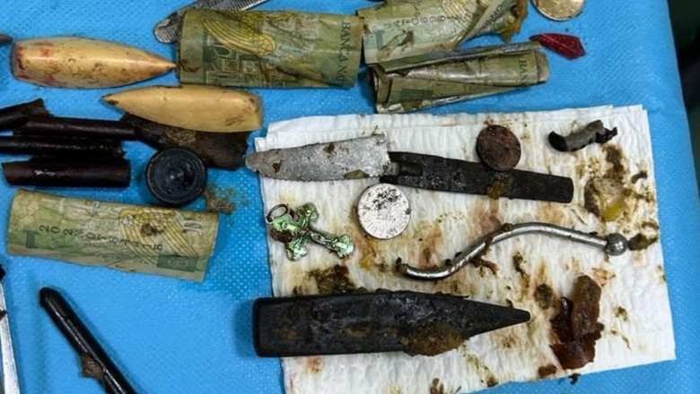 Caz halucinant în țară. Și medicii s-au speriat de ce au găsit în stomacul unui pacient