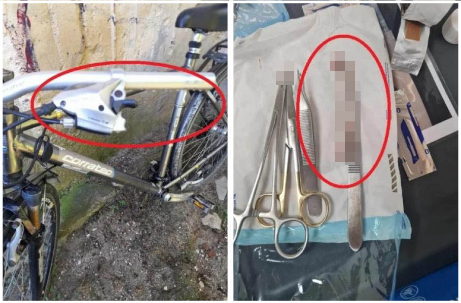 FOTO. Caz halucinant în țară. Mâner de frână de la bicicletă, cusut în piciorul unui pacient. Bărbatul, salvat în Olanda
