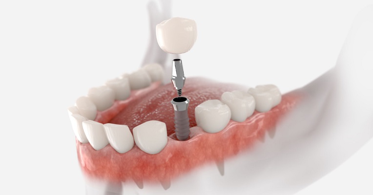 Implanturi dentare: Tot ce trebuie să știi