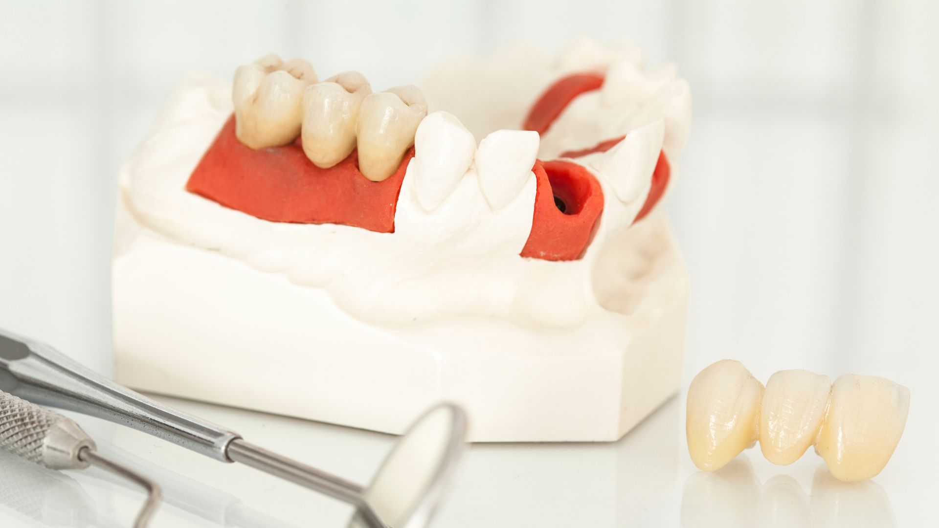 Longevitatea coroanelor dentare: Cat rezista acestea?