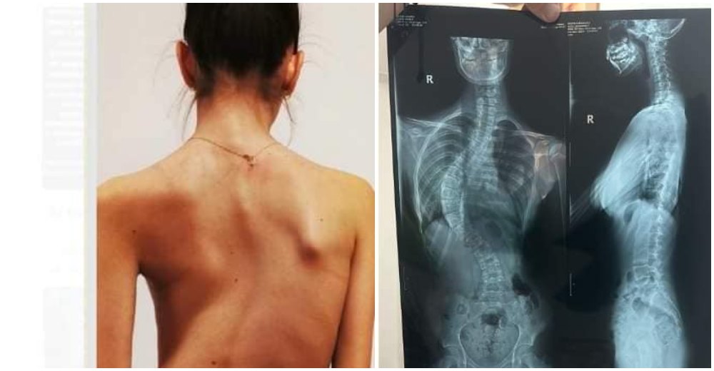 FOTO. Alexandra (14 ani) suferă de o boală gravă. Haideți să o ajutăm să aibă o viață normală!