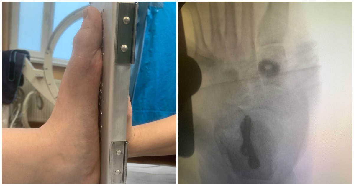 3 simptome ale neuropatiei periferice: ai observat aceste semnale ale corpului tău?