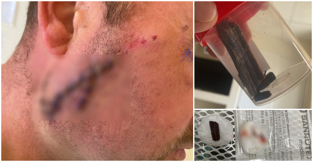 VIDEO. Caz medical șocant. Sătmărean operat după ce bucăți de lemn au fost uitate de medici în față