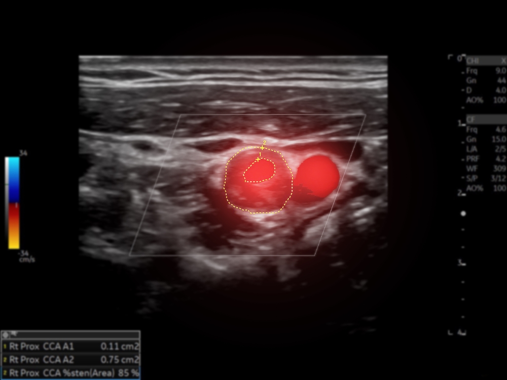 Poate fi prevenit accidentul vascular cerebral? Rolul ecografiei Doppler a arterelor carotide în evaluarea riscului